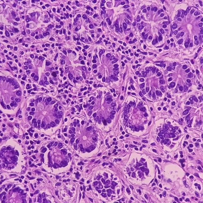 sarcoma